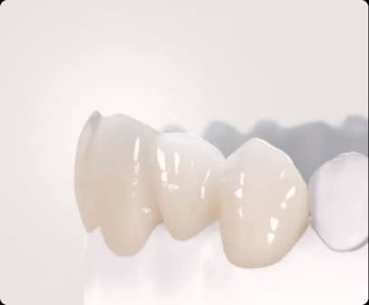Ceramic crowns used to represent comfort-focused dental treatment