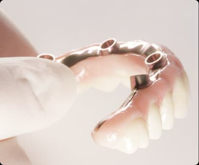 Dental prosthetic restoration model
